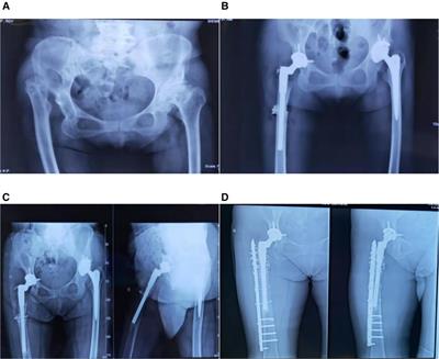 Implant loosening following THA with S-ROM prosthesis and subtrochanteric osteotomy: Three case reports